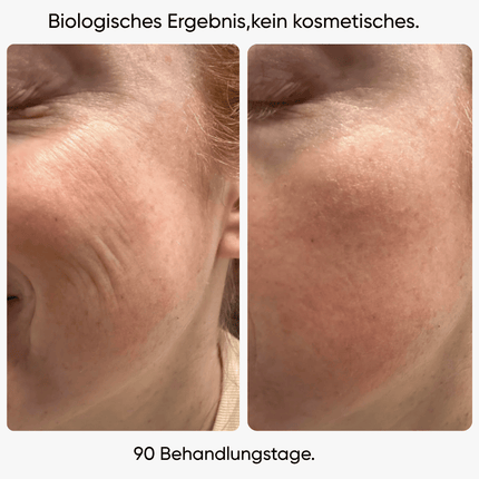PDRN Micro-Infusion┃  Mikro-Nadeln für Zuhause