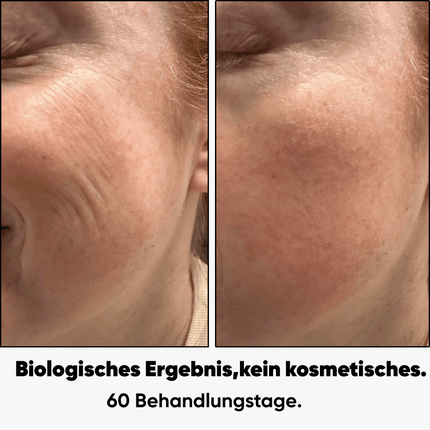 PDRN Micro-Infusion┃  Hauterneuerung für Zuhause